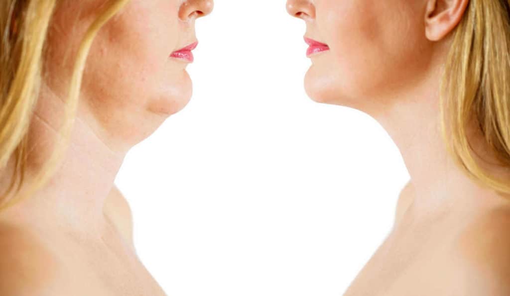 Double Chin treatment Stanford-le-Hope before and after results