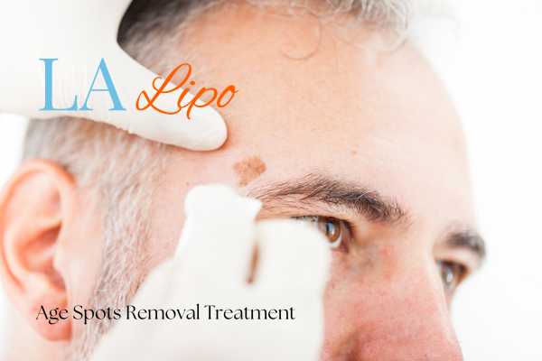 What Are the Most Effective Treatments for Age Spots Stanford-le-Hope?
