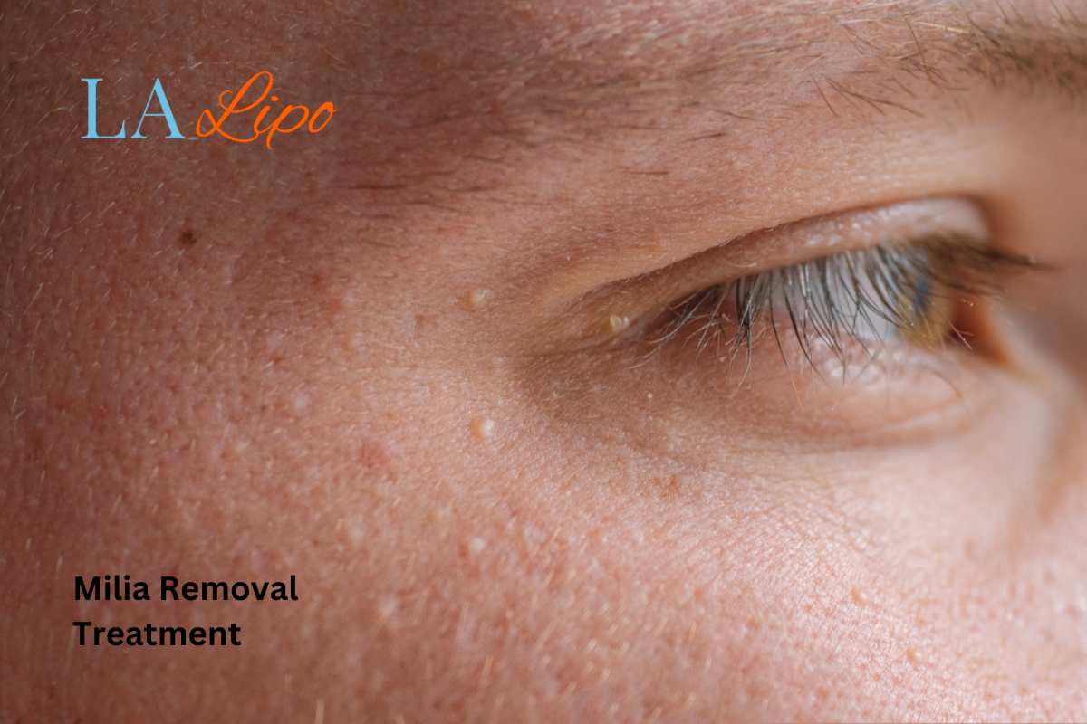 Cryopen Milia Removal: Is It the Easiest and Safest Option Stanford-le-Hope?