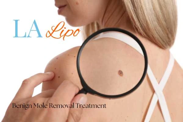 Why getting moles removed Stanford-le-Hope can boost your confidence!