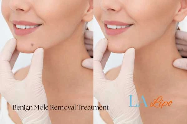 Woman's before and after results of being moles removal treatment Stanford-le-Hope