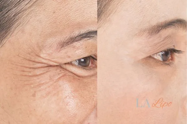 Before and after results of woman - HI-fu wrinkles reduction treatment Stanford-le-Hope