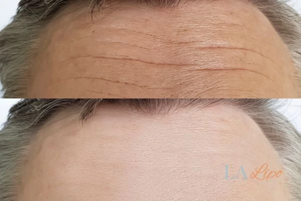 results of HIFU Stanford-le-Hope on mans forehead to help reduce lines and wrinkles