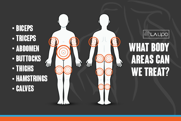 Graphic to show areas you can have LA-EMS Body Sculpting Stanford-le-Hope treatment.