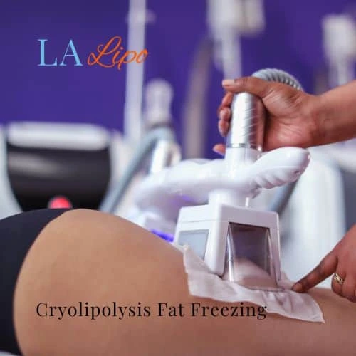 fat freezing - Cryolipolysis Stanford-le-Hope
