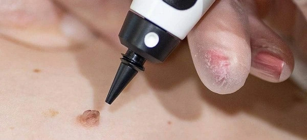 skin tag removal using cryopen Stanford-le-Hope