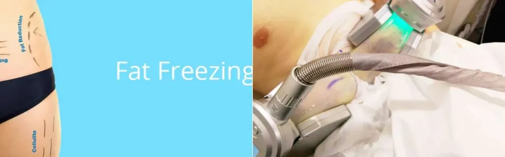 multi areas of a persons body having coolsculpting Stanford-le-Hope treatment