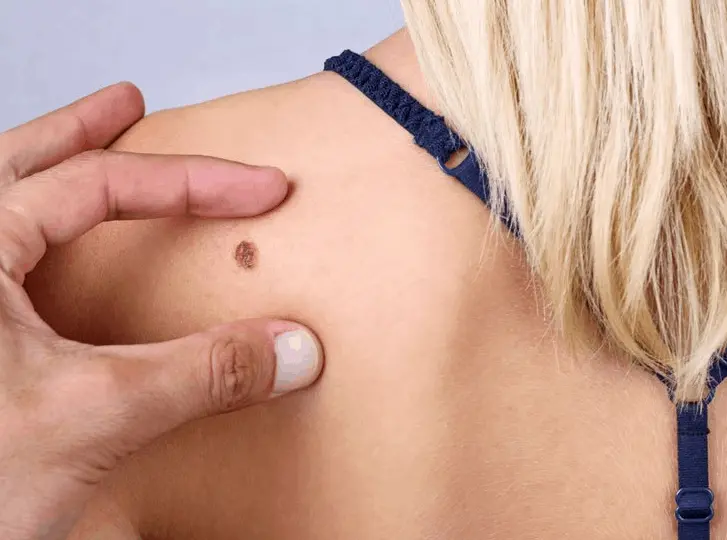 woman having mole removal Stanford-le-Hope consultation before treatment.