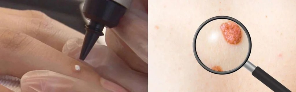 Person getting moles removed with cryopen Stanford-le-Hope