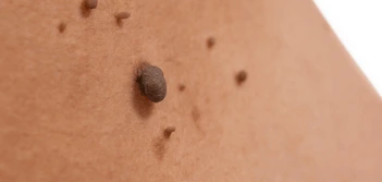 image of a skin tag Stanford-le-Hope