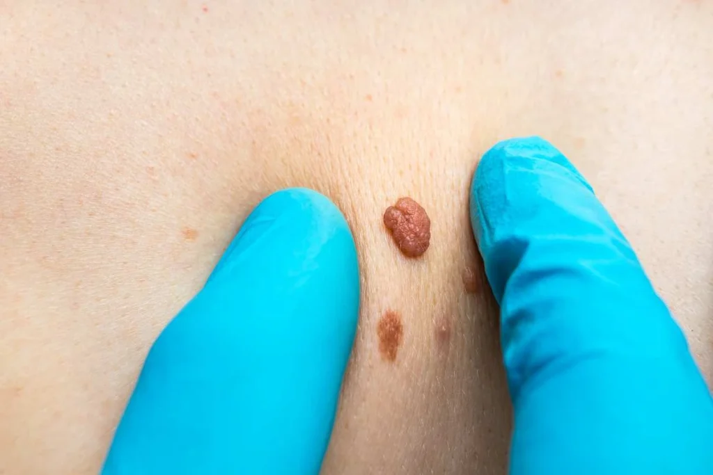 Consultant examining a skin tag Stanford-le-Hope