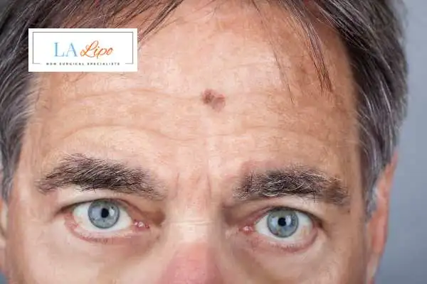 Solar Lentigo Removal Stanford-le-Hope image of man with mark on his forehead