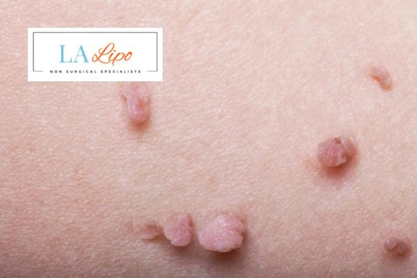 Does cryopen skin tag removal Stanford-le-Hope hurt? Find out now call our team today!