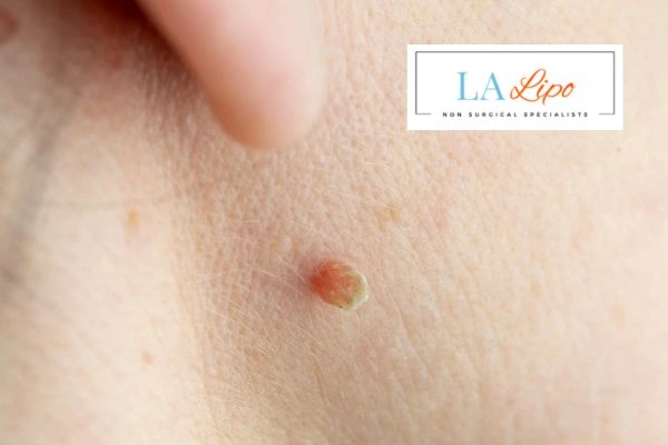 Book skin tag removal Stanford-le-Hope today speak to our team now!