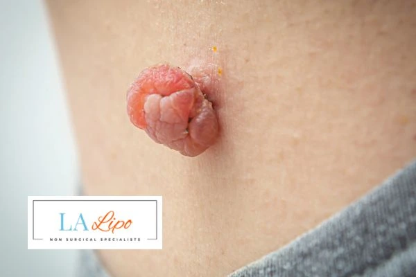 Interested in skin tag removal Stanford-le-Hope? Concerned about the pain? Find out more today!