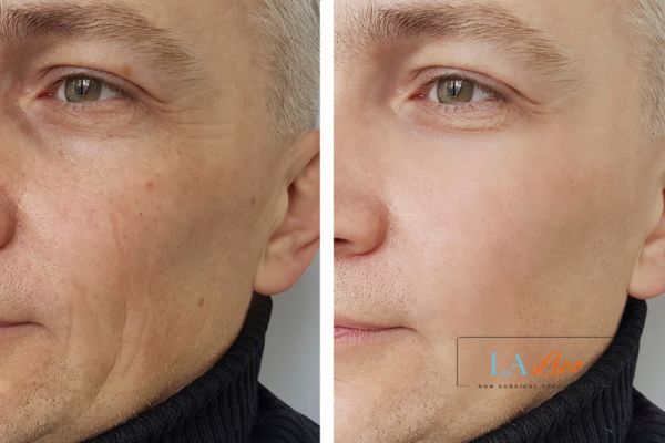 See the amazing results of Morpheus8 Treatment Stanford-le-Hope!