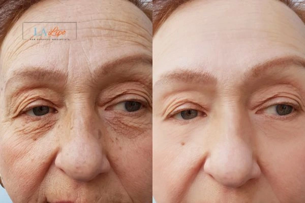 The powerful benefits of Morpheus8 Treatment Stanford-le-Hope - Call Our team today!