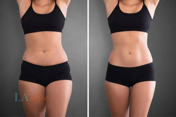 before and after results of non-surgical treatment to help a woman's body image and mental health Stanford-le-Hope
