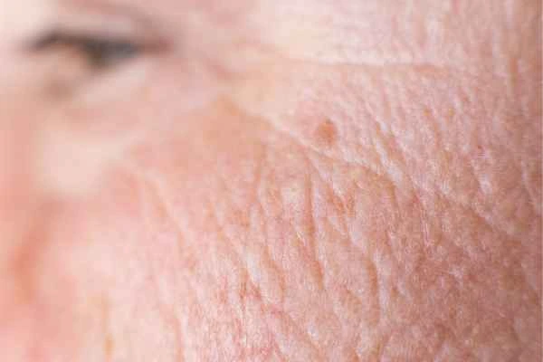 close up picture of a woman's face showing an age spot Stanford-le-Hope