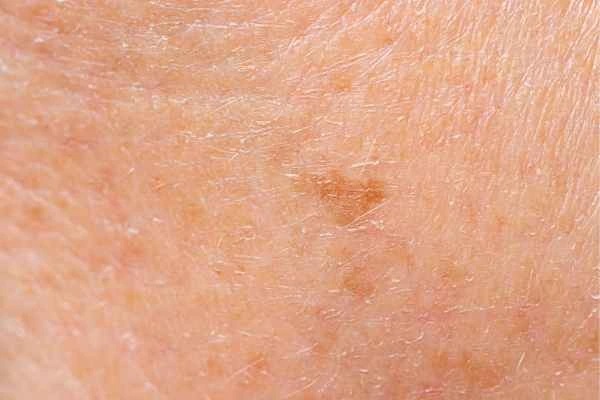 close up picture of age spots Stanford-le-Hope