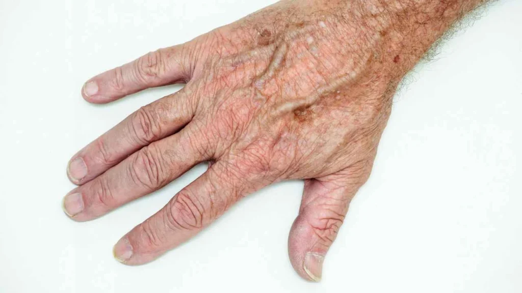 Male hand showing age spot Stanford-le-Hope