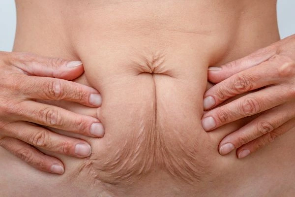 Image of a woman's stomach with loose skin - example of skin tightening Stanford-le-Hope options