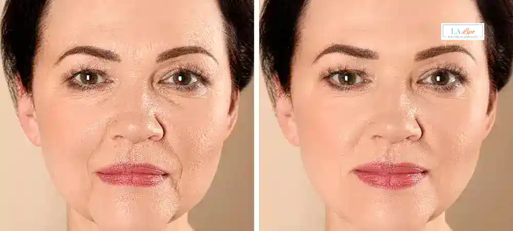 How Long Does It Take to See Results and How Long Do They Last Stanford-le-Hope?