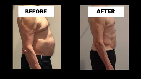 What Symptoms Can Diastasis Recti Cause in Men? Weak Core, Back Pain and Poor Posture Stanford-le-Hope